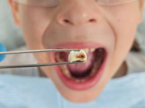 Best Emergency Wisdom Tooth Extraction in Ranlo, NC
